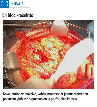 En bloc -resektio