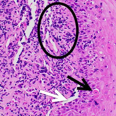 Oesophageal lichen planus – a rare but underdiagnosed disease