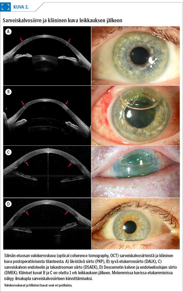 Sarveiskalvosiirre ja kliininen kuva leikkauksen jälkeen<p/>