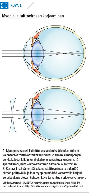 Myopia ja taittovirheen korjaaminen<p/>