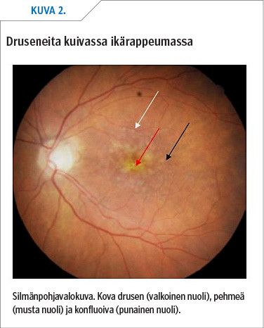 Druseneita kuivassa ikärappeumassa