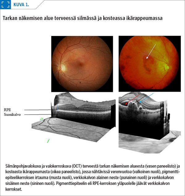 Tarkan näkemisen alue terveessä silmässä ja kosteassa ikärappeumassa