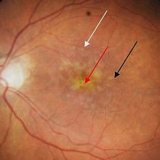 VEGF-A inhibitors have revolutionized the treatment of age-related macular degeneration