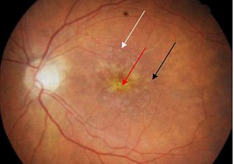 VEGF-A inhibitors have revolutionized the treatment of age-related macular degeneration