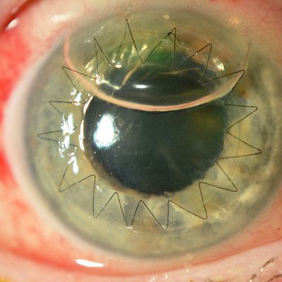 Corneal transplantations