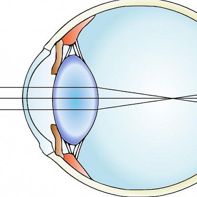 Myopia – maailmanlaajuinen epidemia