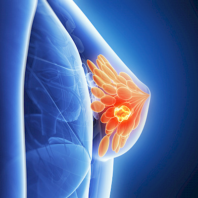 Ribosiklibin ja letrotsolin yhdistelmällä yli vuosi lisää elinaikaa levinneessä rintasyövässä