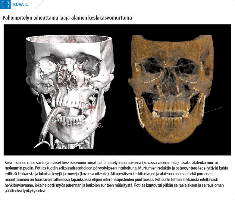 Pahoinpitelyn aiheuttama laaja-alainen keskikasvomurtuma <p/>