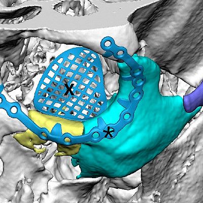 Modern diagnosis and treatment of patients with facial fractures:
Do you recognize specific features of facial fractures?