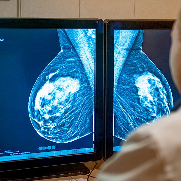 Pandemia vähensi rintasyöpien ja ihomelanoomien toteamista