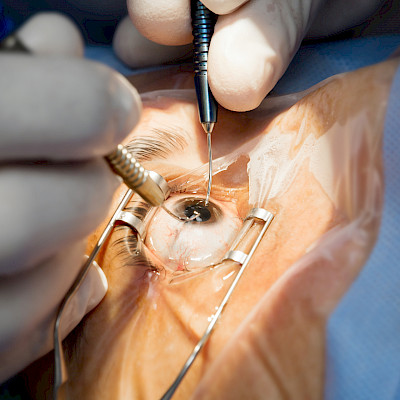 Ophthalmic procedures in Finland 2010–2016