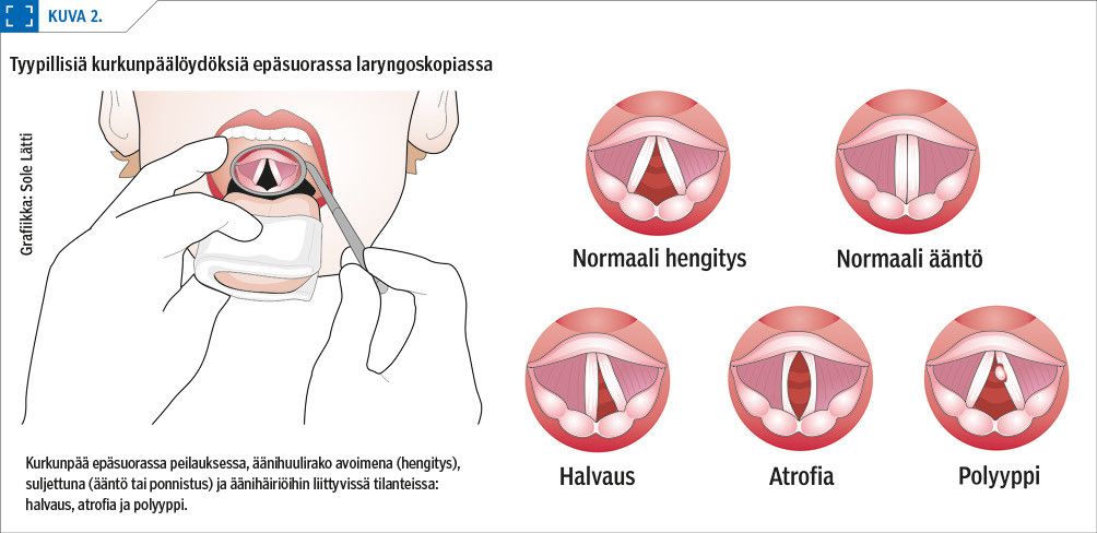Tyypillisiä kurkunpäälöydöksiä epäsuorassa laryngoskopiassa