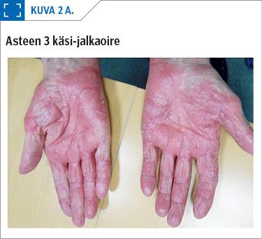 Asteen 3 käsi-jalkaoire