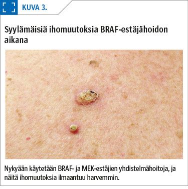 Syylämäisiä ihomuutoksia BRAF-estäjähoidon aikana