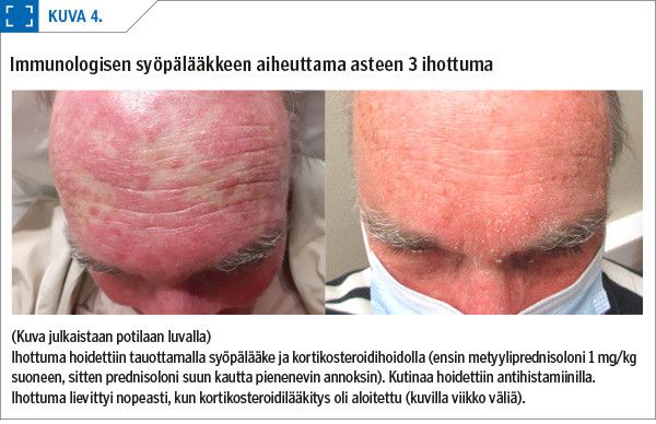 Immunologisen syöpälääkkeen aiheuttama asteen 3 ihottuma