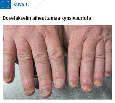 Dosetakselin aiheuttamaa kynsivauriota