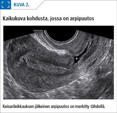 Kaikukuva kohdusta, jossa on arpipuutos