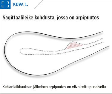 Sagittaalileike kohdusta, jossa on arpipuutos