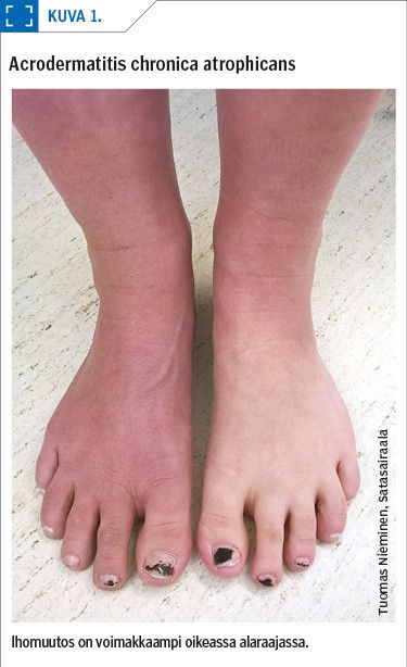 Acrodermatitis chronica atrophicans<p/>