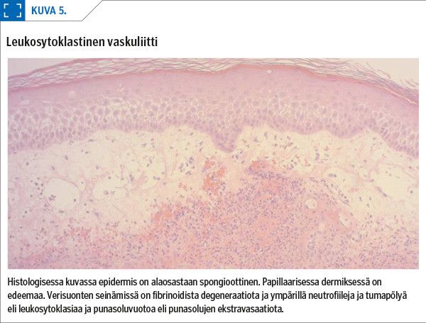 Leukosytoklastinen vaskuliitti<p/>