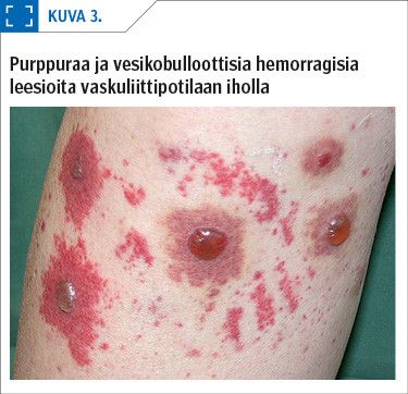 Purppuraa ja vesikobulloottisia hemorragisia leesioita vaskuliittipotilaan iholla<p/>