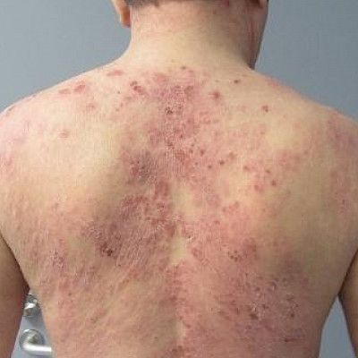 Treatment of severe atopic eczema