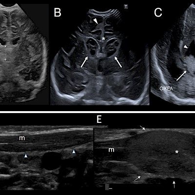 Choose wisely the imaging tools for a child. When is ultrasound the primary diagnostic method?