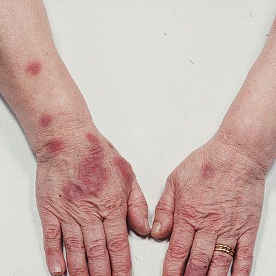 Drug-induced skin reactions