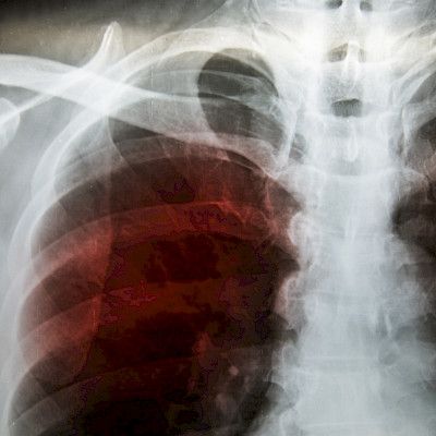 Muista tuberkuloosin mahdollisuus ukrainalaisen potilaan kohdalla