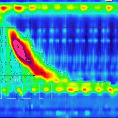 Practical implications of Chicago classification version 4.0 on high-resolution oesophageal manometry