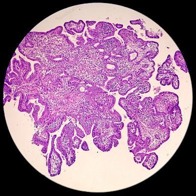 Voiko prostatektomian tehdä ilman edeltävää biopsiaa?