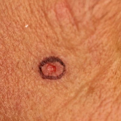 Skin biopsy in dermatologic conditions