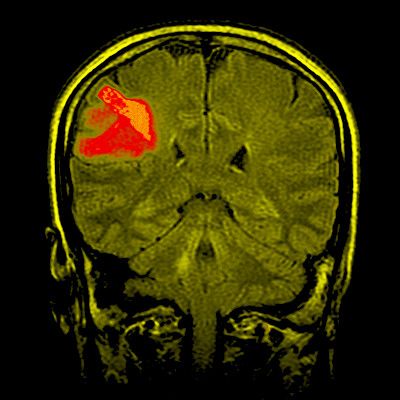 Primary central nervous system lymphoma: the first national guideline