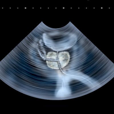 Darolutamidi tehoaa myös hormonisensitiiviseen etäpesäkkeiseen eturauhassyöpään