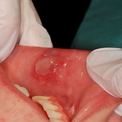 Oral mucosal lesions in children and adolescents