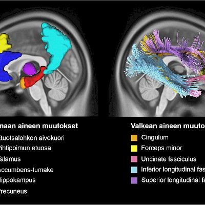 Remission and treatment of depression alter the structure of the brain