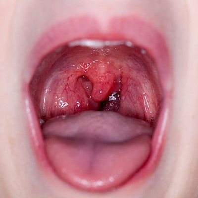 Surgical treatment of benign tonsil-related diseases