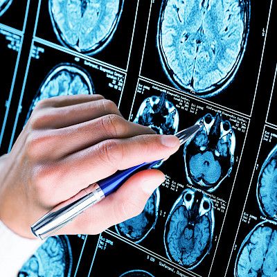 IS: Merkittävää Alzheimer-tutkimusta epäillään osin väärennetyksi