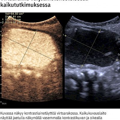 Imaging of vesicoureteral reflux by contrast-enhanced voiding urosonography