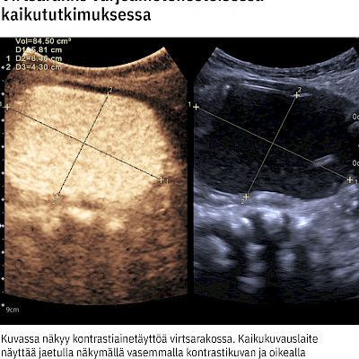 Virtsan takaisinvirtauksen kuvantamiseen löytyy säteetön vaihtoehto