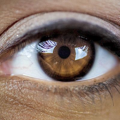 Arviointi valmistui tebentafuspinista silmän suonikalvoston melanoomassa