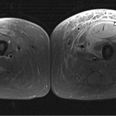 Muscle infarction – a rare microvascular complication in a middle-aged woman with complicated type 1 diabetes