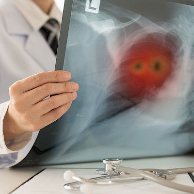 Keuhkosyöpäpotilaan seurantakäytäntöjä on syytä arvioida kriittisesti