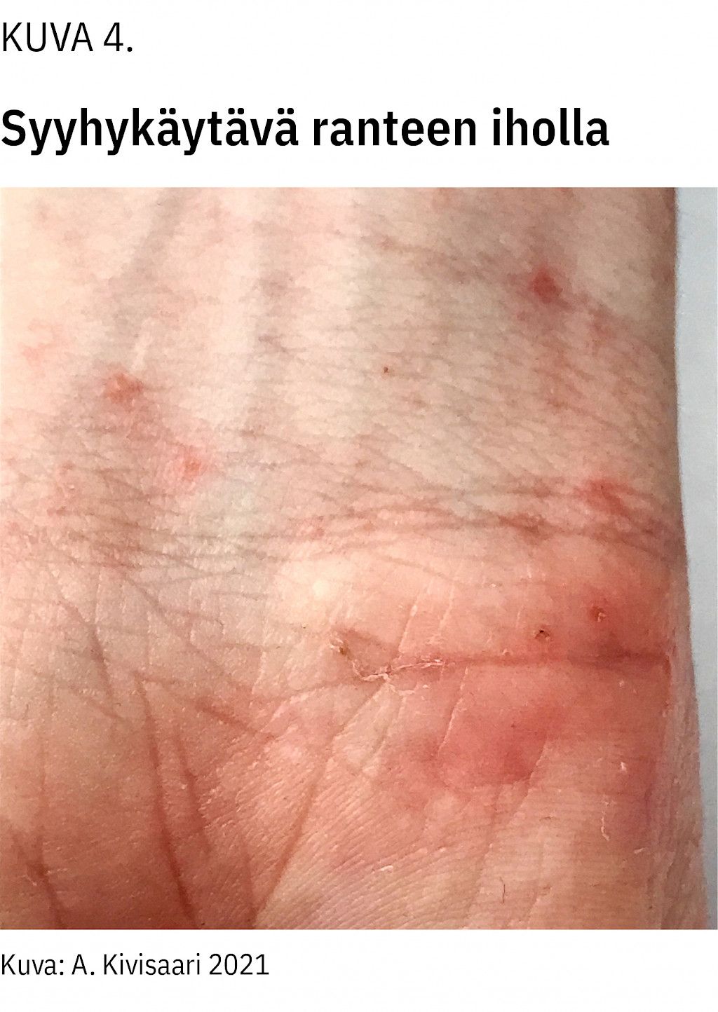 Muista Syyhy Kun Selvit t Kutinan Syyt L k rilehti Muista Syyhy Kun Selvit t Kutinan Syyt L k rilehti
