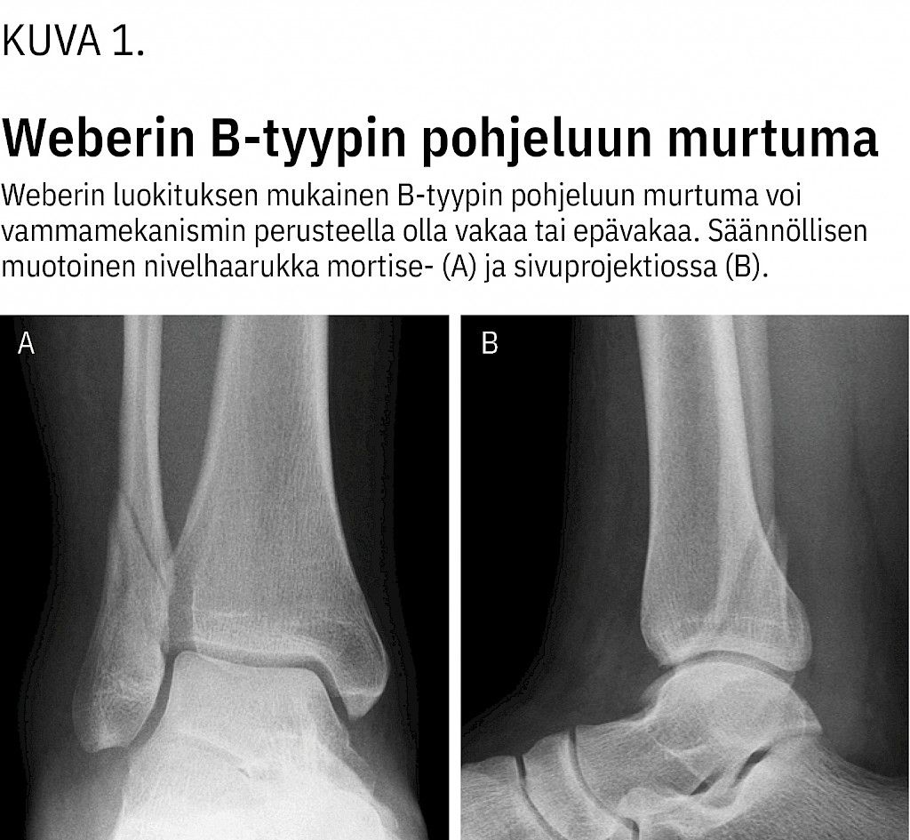 Nilkkamurtumista Yli Puolet Voidaan Hoitaa Konservatiivisesti 
