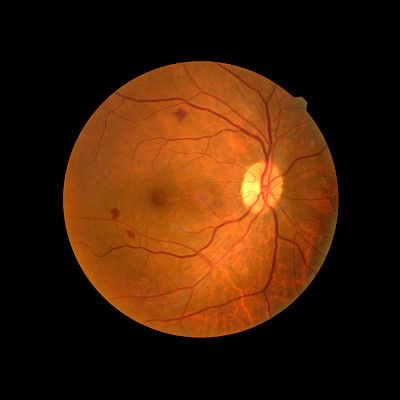 Diabetes yleistyy, diabeettinen retinopatia ei