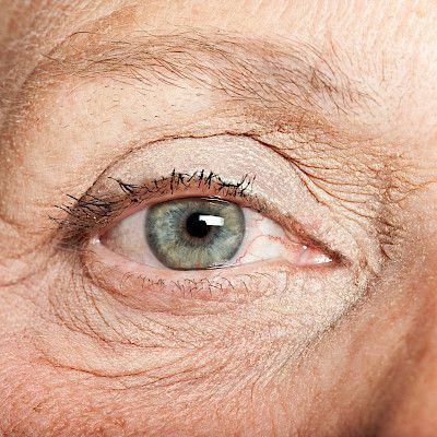 Silmänpohjan ikärappeuman aiheuttama näkövammaisuus kääntynyt laskuun