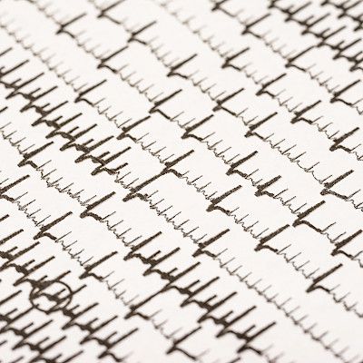 EKG:n tekoälyanalyysi voi ennustaa eteisvärinää