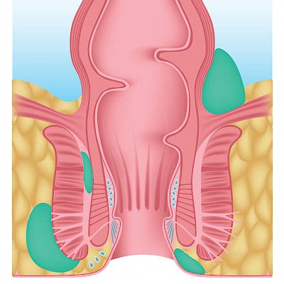 Miten perianaalipaise kannattaa hoitaa?