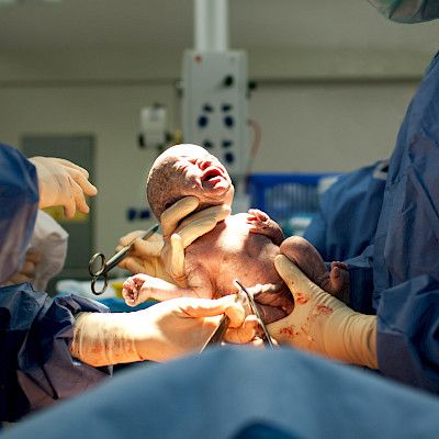 Kiire vähensi toimenpiteitä pienissä synnytyssairaaloissa